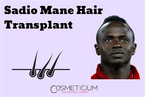 Sadio Mane Hair Transplant | Rumor or Real? - Cosmeticium