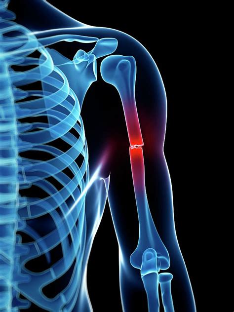 Bone fracture - artofloki