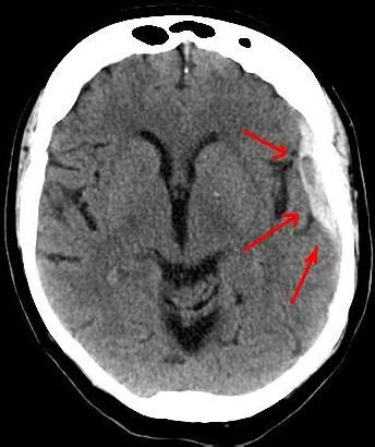 Hit Head? Bleeding in Brain Symptoms Can Occur Six Weeks Later » Scary ...