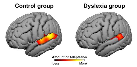 Distinctive brain pattern may underlie dyslexia