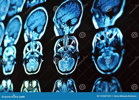 Magnetic Resonance Image Scan of the Brain. MRI Film of a Human Skull ...