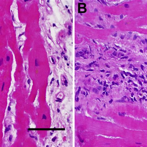 Endomyocardial biopsy images from patient 1 (A and B). The biopsy... | Download Scientific Diagram