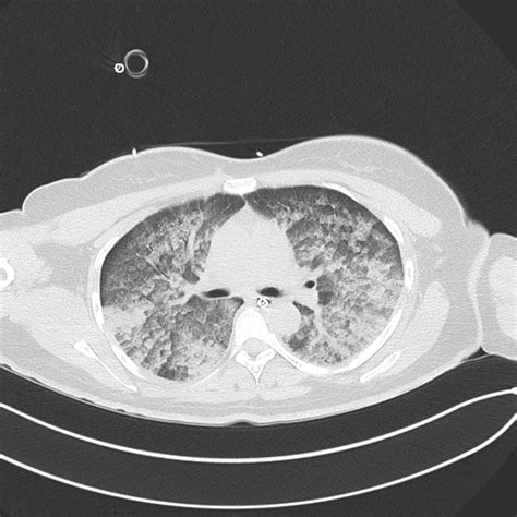 Ct Chest Pulmonary Edema