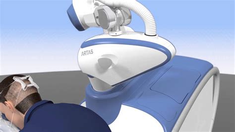 ARTAS robotic hair transplant - Houston hair restoration - YouTube