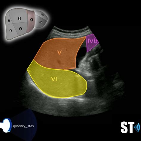 Couinaud’s Liver Segments – Sonographic Tendencies | Segmentation ...