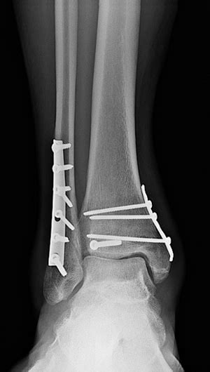 Broken Ankle: Types of Fractures, Diagnosis & Treatments | HSS