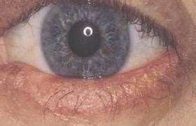 How To Treat EyeLid Mites ~ EyeLash Demodex Mites