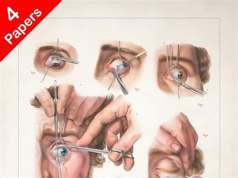 STRABISMUS SURGERY AMBLYOPIA Anatomy Art Print for Medical - Etsy