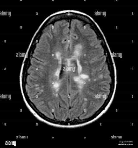 MRI of Multiple Sclerosis Stock Photo - Alamy