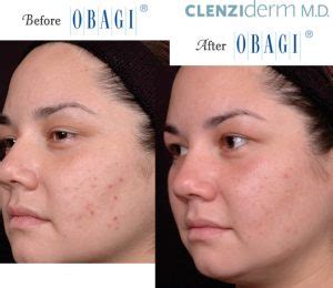 Obagi® Before and After Pictures – Micki Ly M.D. Maui Dermatologist