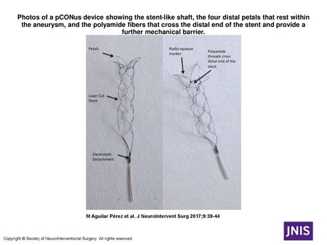 Photos of a pCONus device showing the stent-like shaft, the four distal petals that rest within ...