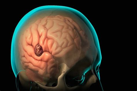 Craniotomy Treatment & Cost Guide