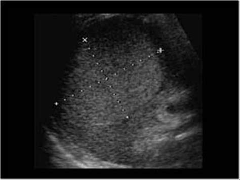 Abdomen and retroperitoneum | 1.4 Spleen : Case 1.4.2 Benign mass lesion of the spleen ...