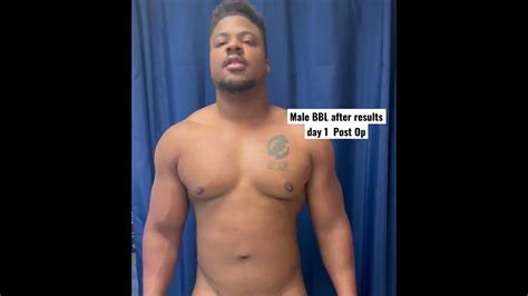 Male BBL after results day 1 Post Op - YouTube