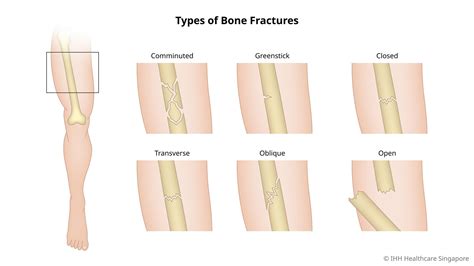 Bone Fractures - Symptoms & Causes | Parkway Shenton