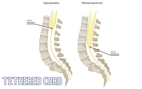 Tethered Cord – condition and symptoms - how to treat