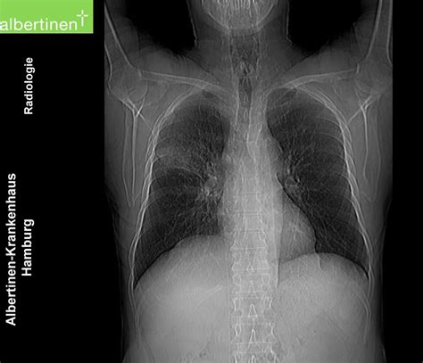 CT-scan of the thorax: Atypical pneumonia - DocCheck