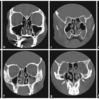 Noncontrast coronal sinus CT scans. a This is a normal study. The ...