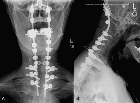 Cureus | Posterior Cervical Fusion of Occiput-T3 for Unstable Complex Odontoid Fracture in an 80 ...