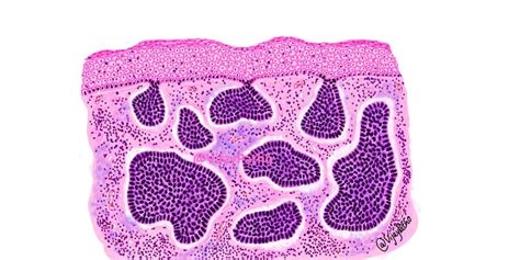 BASAL CELL CARCINOMA - Pathology Made Simple