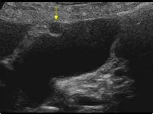 Abdomen and retroperitoneum | 1.2 Gallbladder and bile ducts : Case 1.2.14 Gallbladder ...