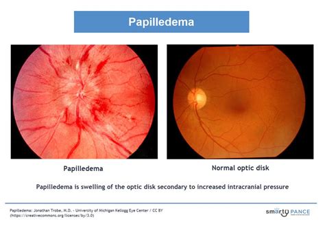 Papilledema (ReelDx) - Smarty PANCE