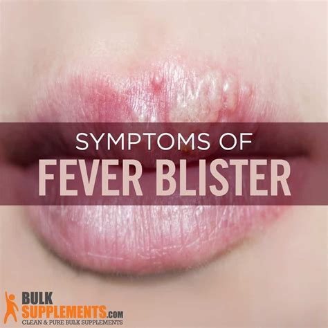 Fever Blisters: Causes, Symptoms & Treatments | BulkSupplements