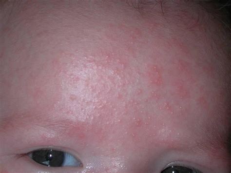 Skin Rashes in Children on Face in Adults on Hands on Arms that Itch In ...