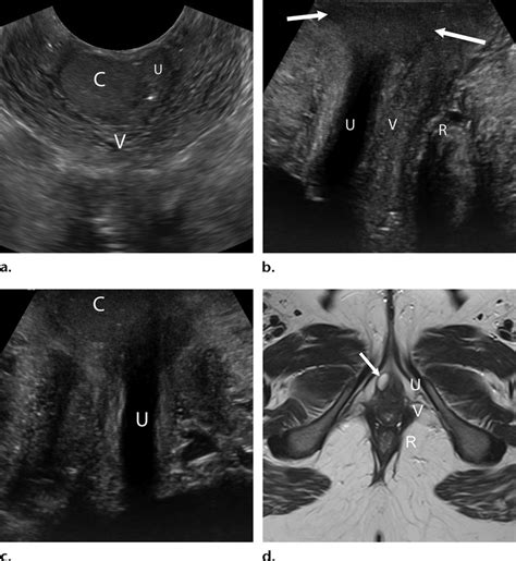 Skene gland cyst in a 41-year-old woman who presented with pelvic pain ...