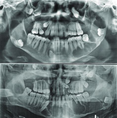 Pre-operative orthopantomogram of Patient 1 (upper) and Patient 2 ...