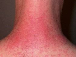 Itchy Rash on the Neck - Causes, Prevention and Treatment