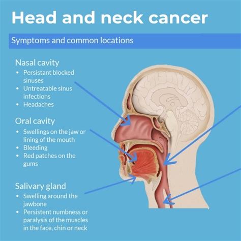 Head and neck cancer infographic - Oncology Central