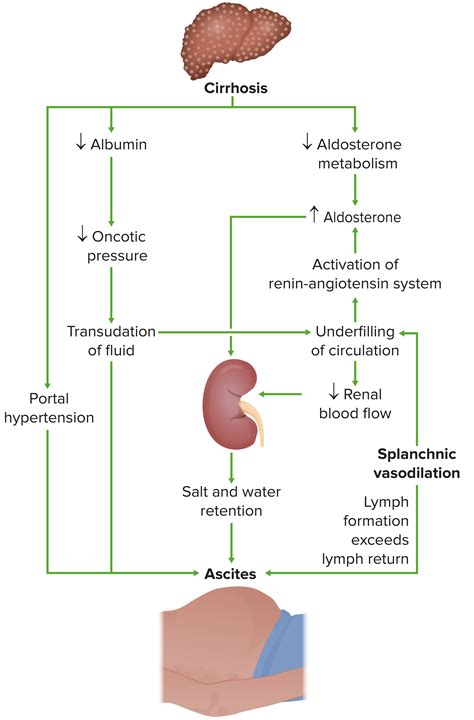 Ascites | Concise Medical Knowledge