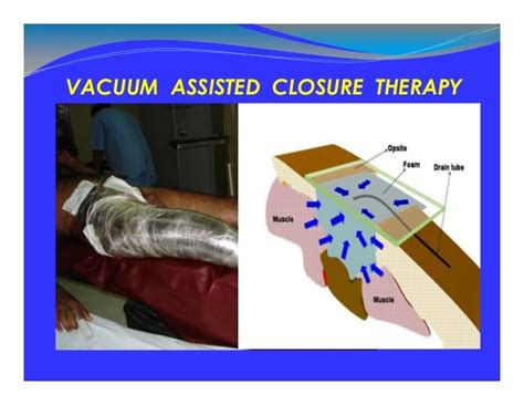 Vacuum assisted closure conference presentation