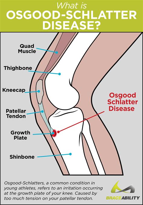 Osgood Schlatter Surgery | Osgood-Schlatter's Disease Adults Procedure