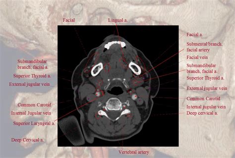 r@diOlogY dE aruN: Carotid Angio CT Vascular Anatomy