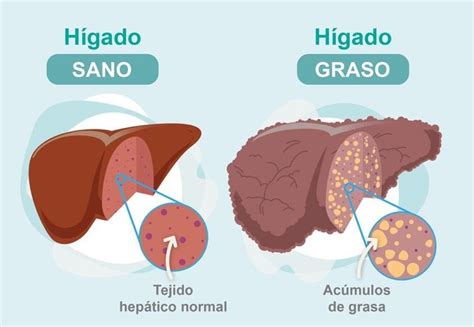 Una investigación muestra que la enfermedad del hígado graso pone en peligro la salud del ...