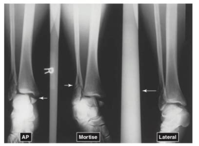 Bimalleolar Fracture Diagram | Quizlet