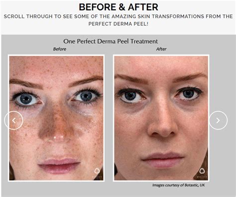 The Perfect Derma Peel Dermatology Care of Charlotte | Dermatology Care ...