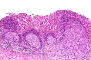 Diversion Colitis - Ulcerative Colitis Causes And Symptoms / Diversion colitis can be easily ...