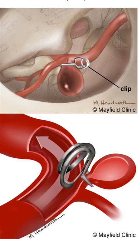 Figure 4 from Aneurysm clipping. | Semantic Scholar