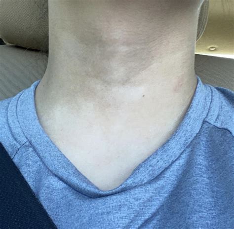 Discoloration on neck? : r/skin