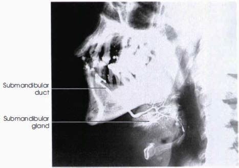 Sialography Procedure and Steps Online - RadTechOnDuty