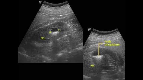 Renal cyst with milk of calcium 밀크 칼슘 동반 신장 낭종 - YouTube