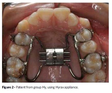 View 5 Hyrax Appliance Before And After - bezzantscompics