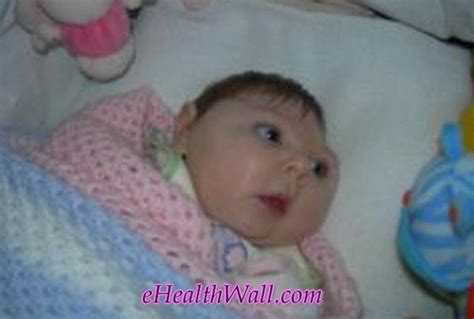 Microcephaly - Pictures, Definition, Causes, Life Expectancy, Prognosis