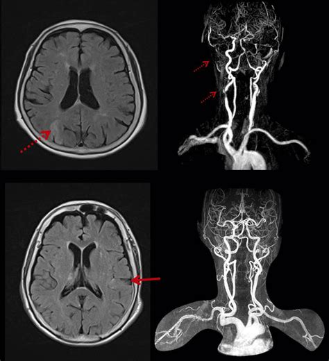 Magnetic resonance (MR) imaging of patients with ischemic stroke and ...