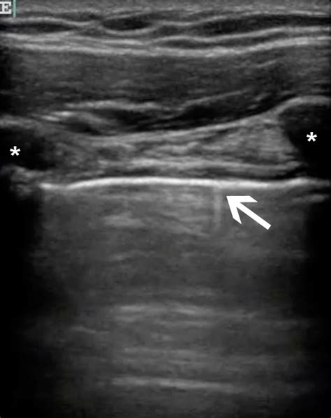 Clinician-performed Beside Ultrasound for the Diagnosis of Traumatic Pneumothorax - The Western ...