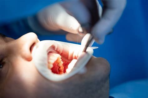 What to Expect During a Wisdom Tooth Extraction? - D. Dental