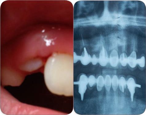 Jaw Bone Coming Through Gum After Tooth Extraction, What to Do?